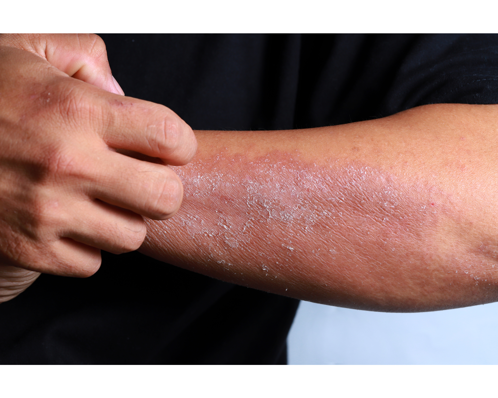 Symptoms like eczema are caused if the gut skin axis is not in balance.