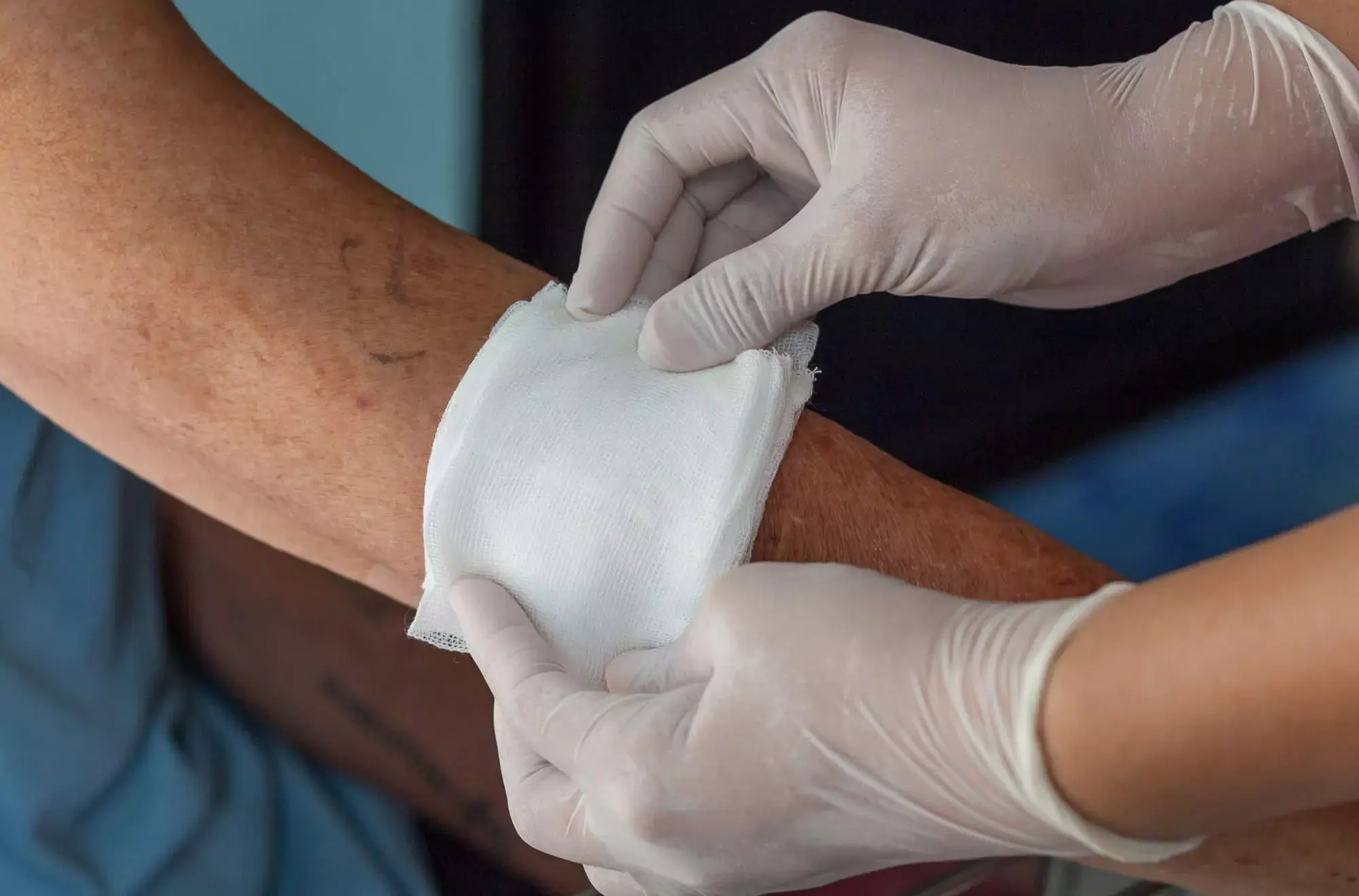 A clay poultice can be applied and then wrapped with gauze.