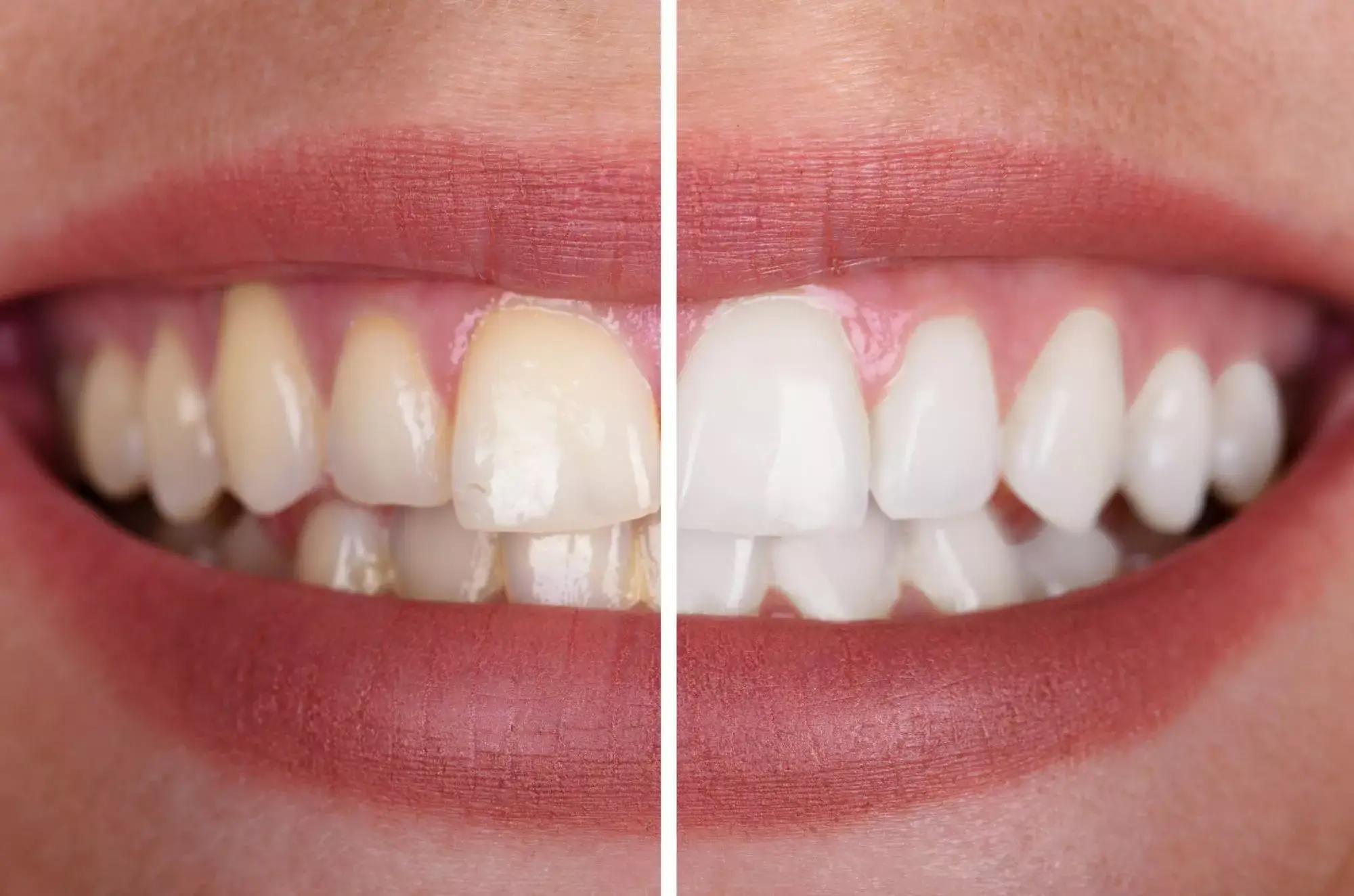 A mixture of bentonite clay can be used to brighten and whiten your teeth.